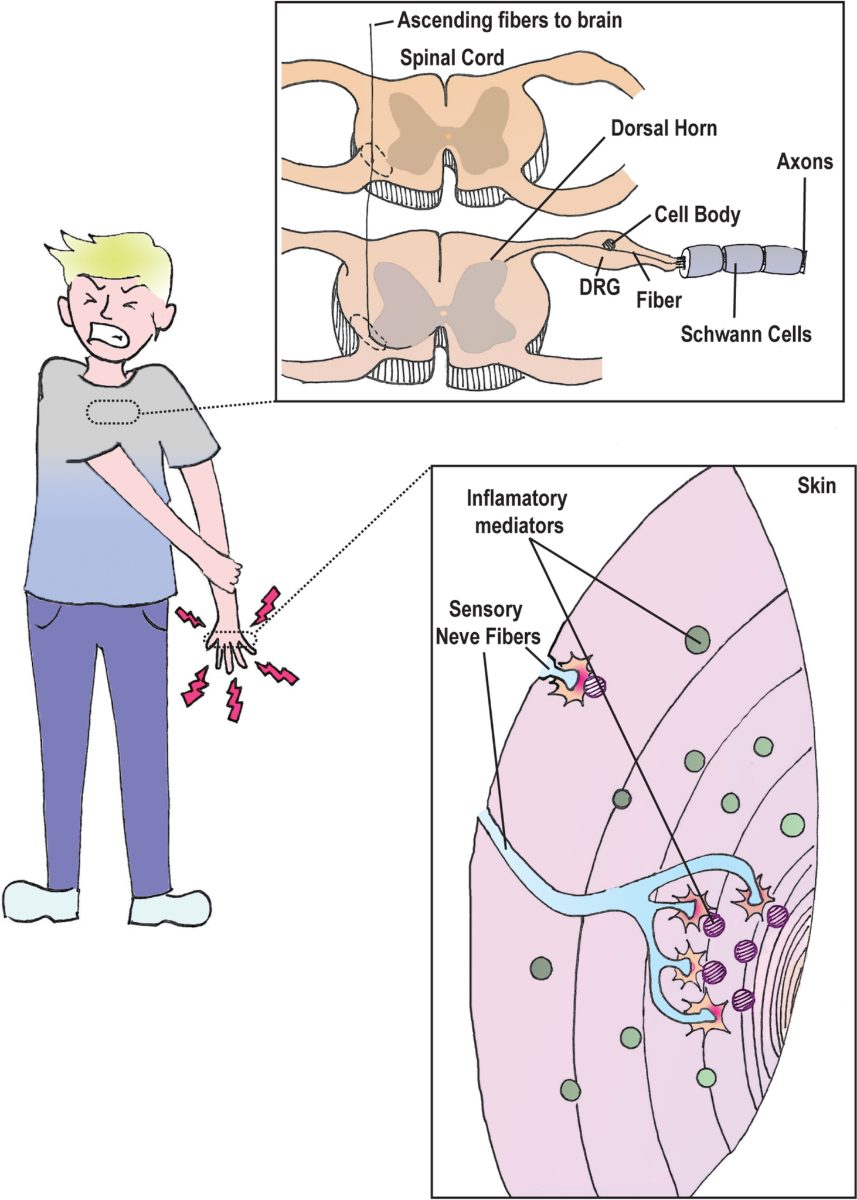 Schematic of a pain pathway from inflamed skin through sensory nerve fibers and the dorsal root ganglion to the spinal cord dorsal horn
