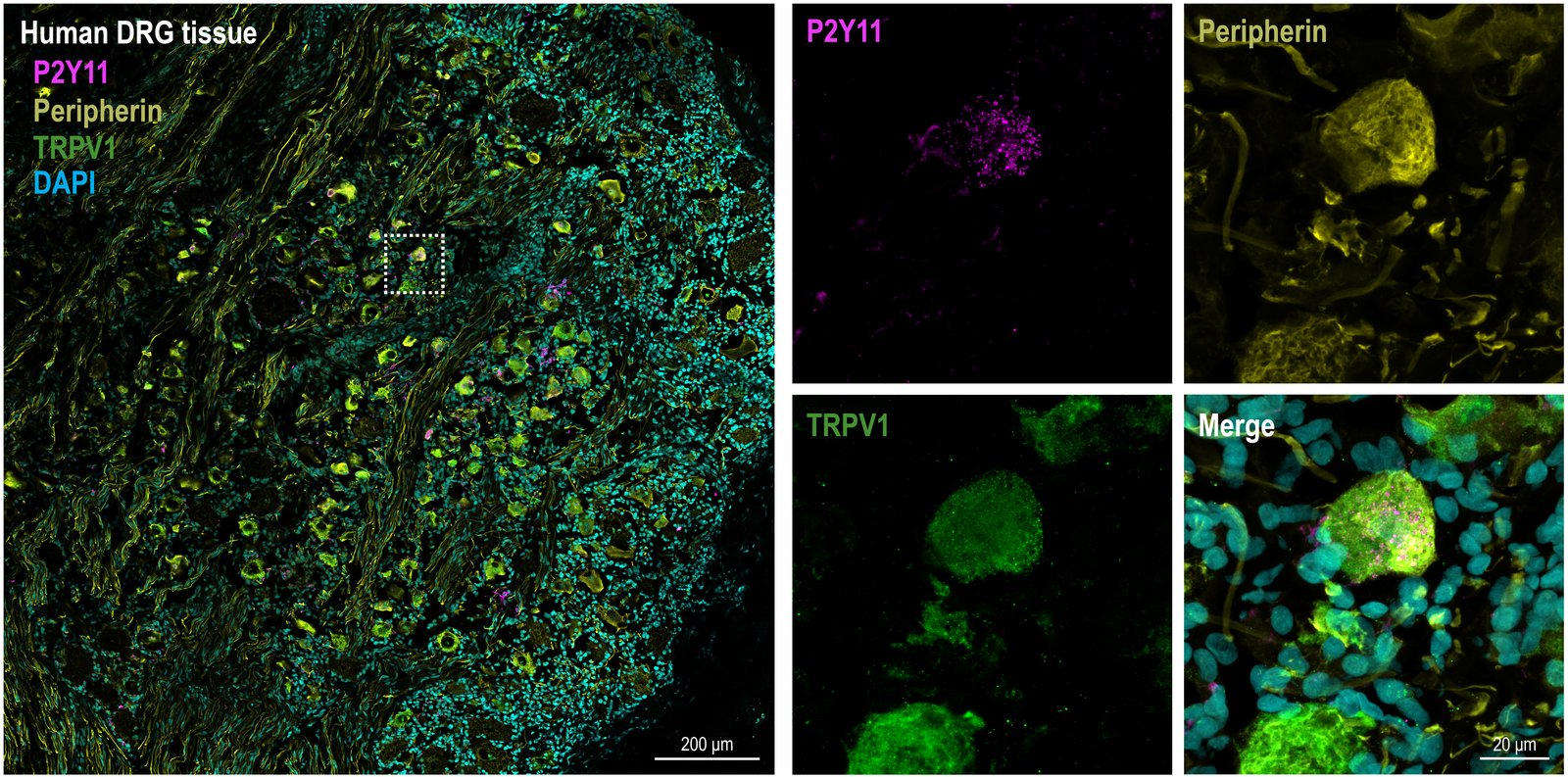 Immunofluorescence of human DRG tissue. A boxed neuron is enlarged in four panels showing P2Y11 in magenta, peripherin in yellow, TRPV1 in green, and a merged view with DAPI-stained nuclei in cyan.